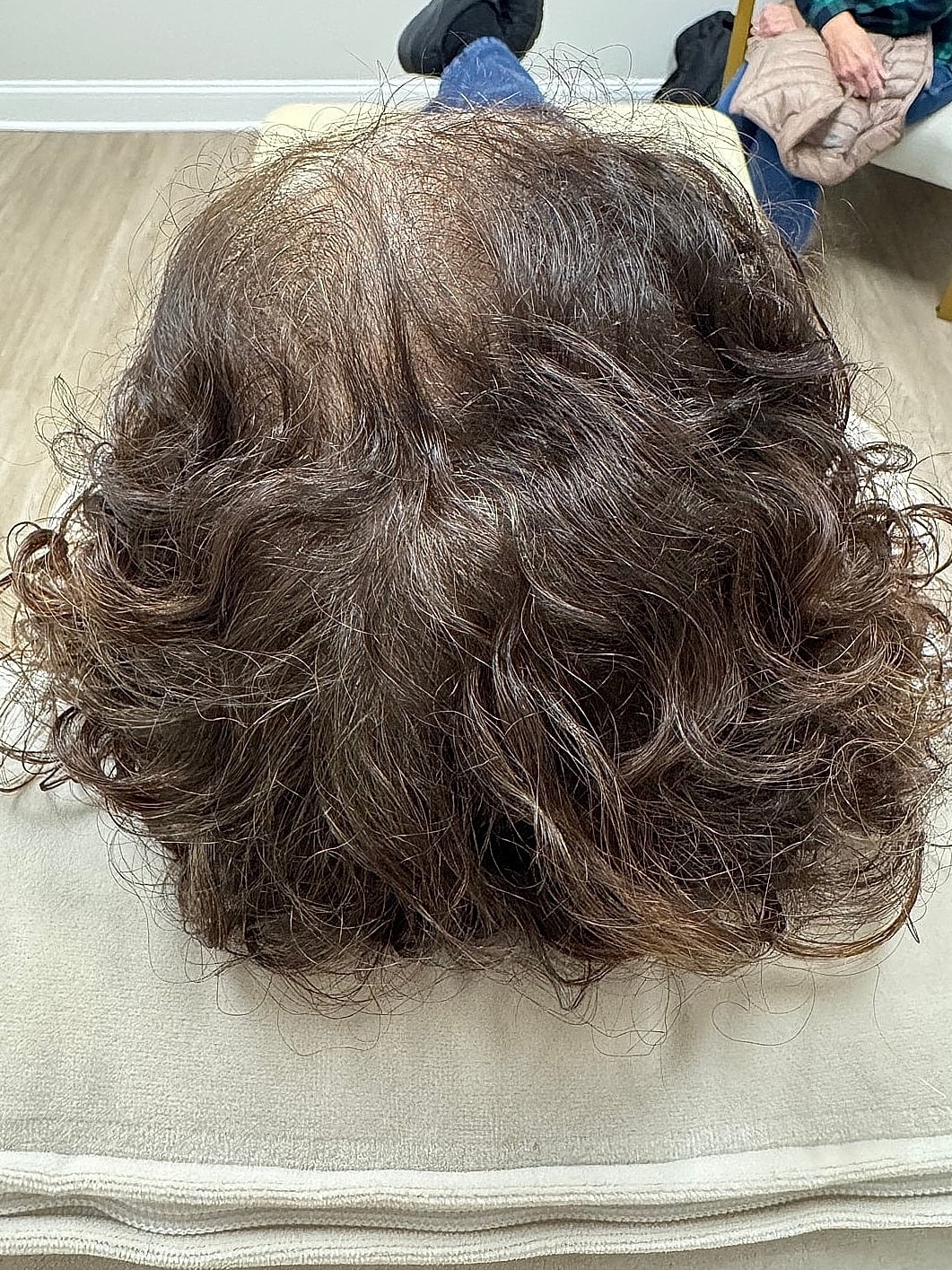 Hair Restoration Gallery Before & After