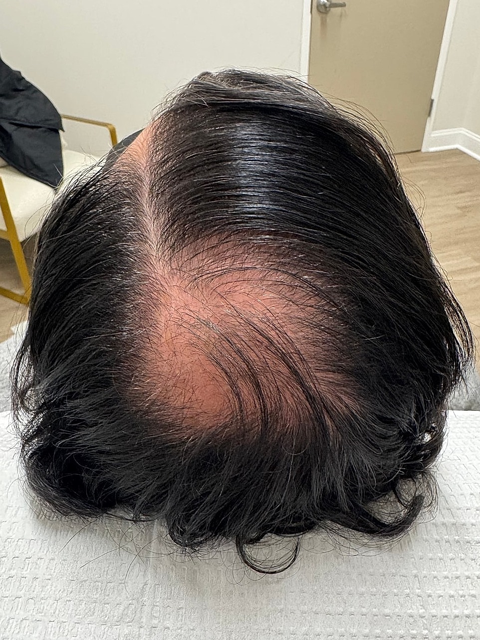 Hair Restoration Gallery Before & After