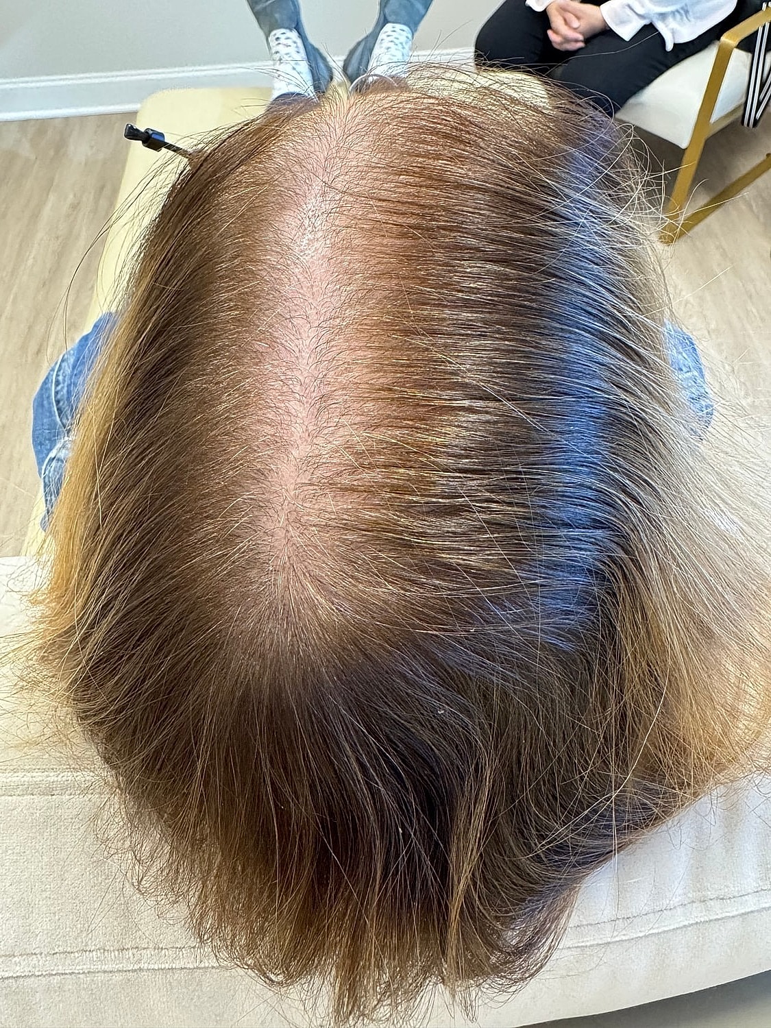 Hair Restoration Gallery Before & After