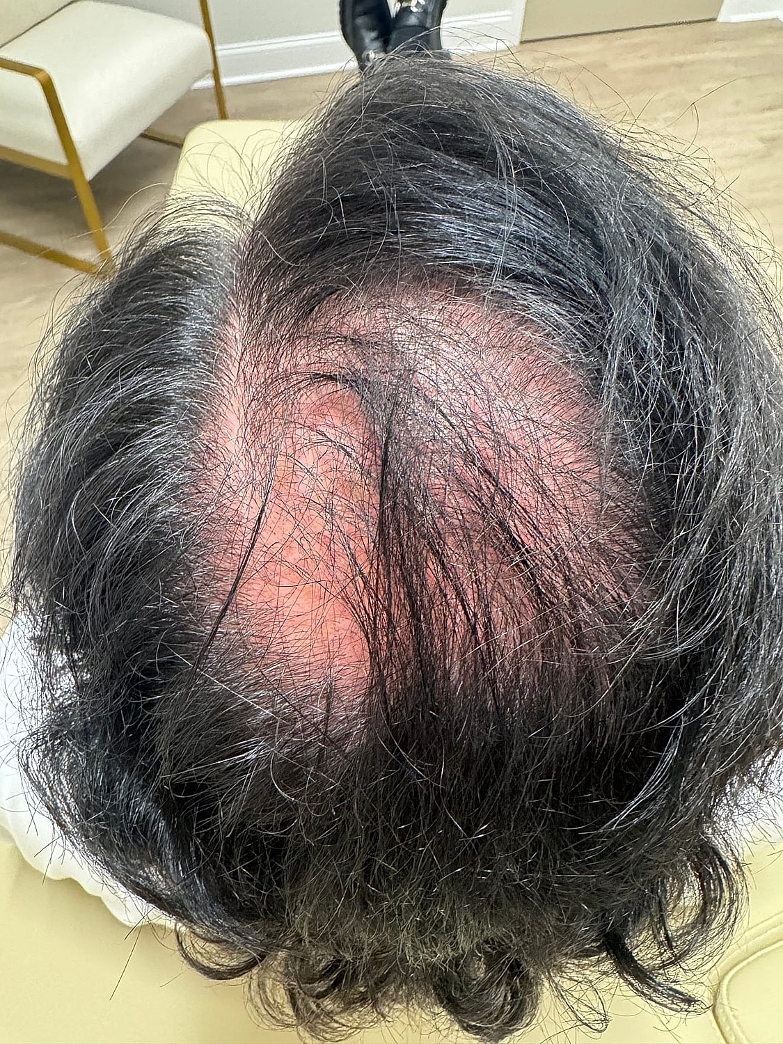 Hair Restoration Gallery Before & After