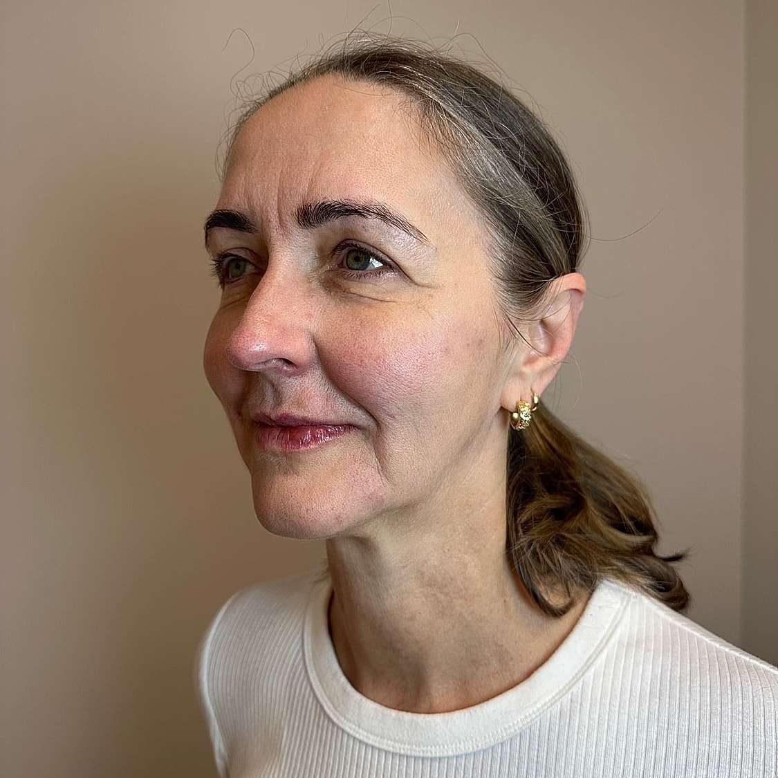 Full Facial Balancing Gallery Before & After