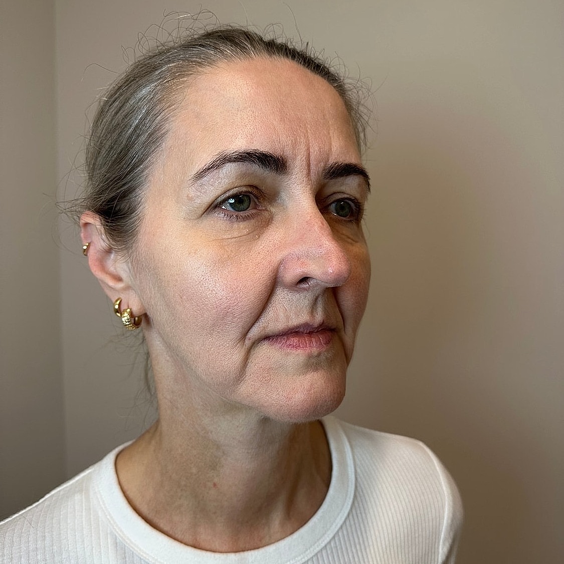 Full Facial Balancing Gallery Before & After