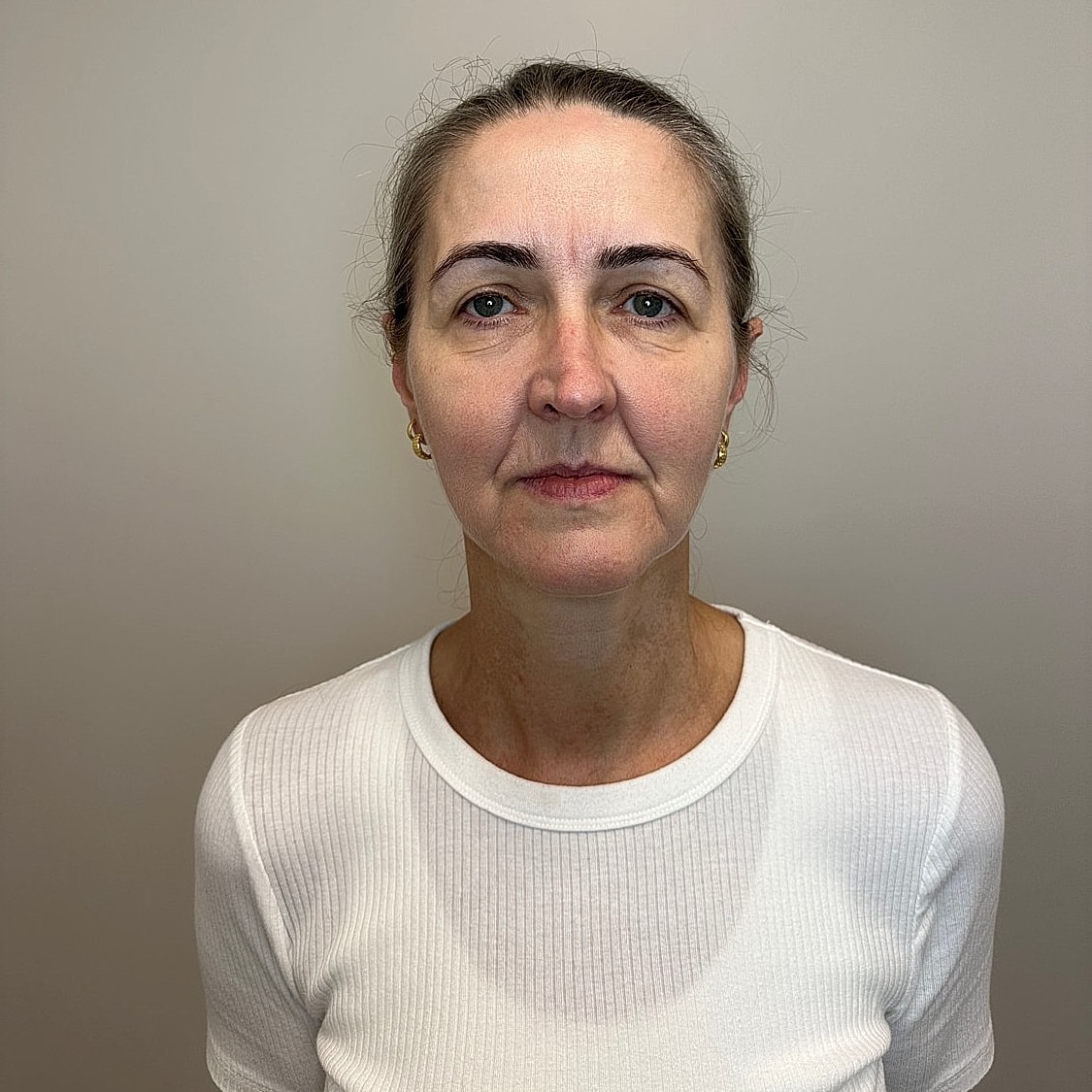 Full Facial Balancing Gallery Before & After