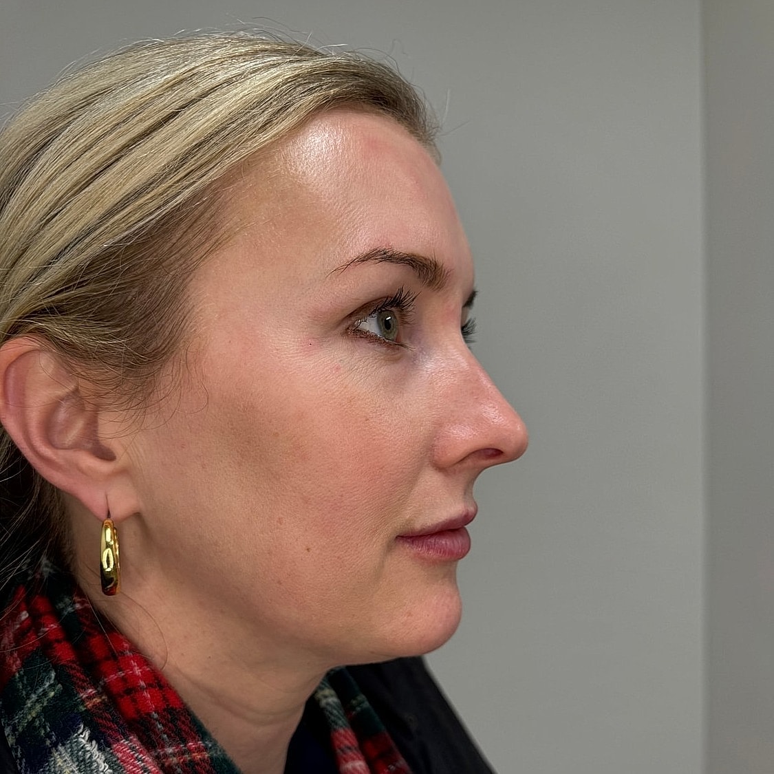 Lip Filler Before & After