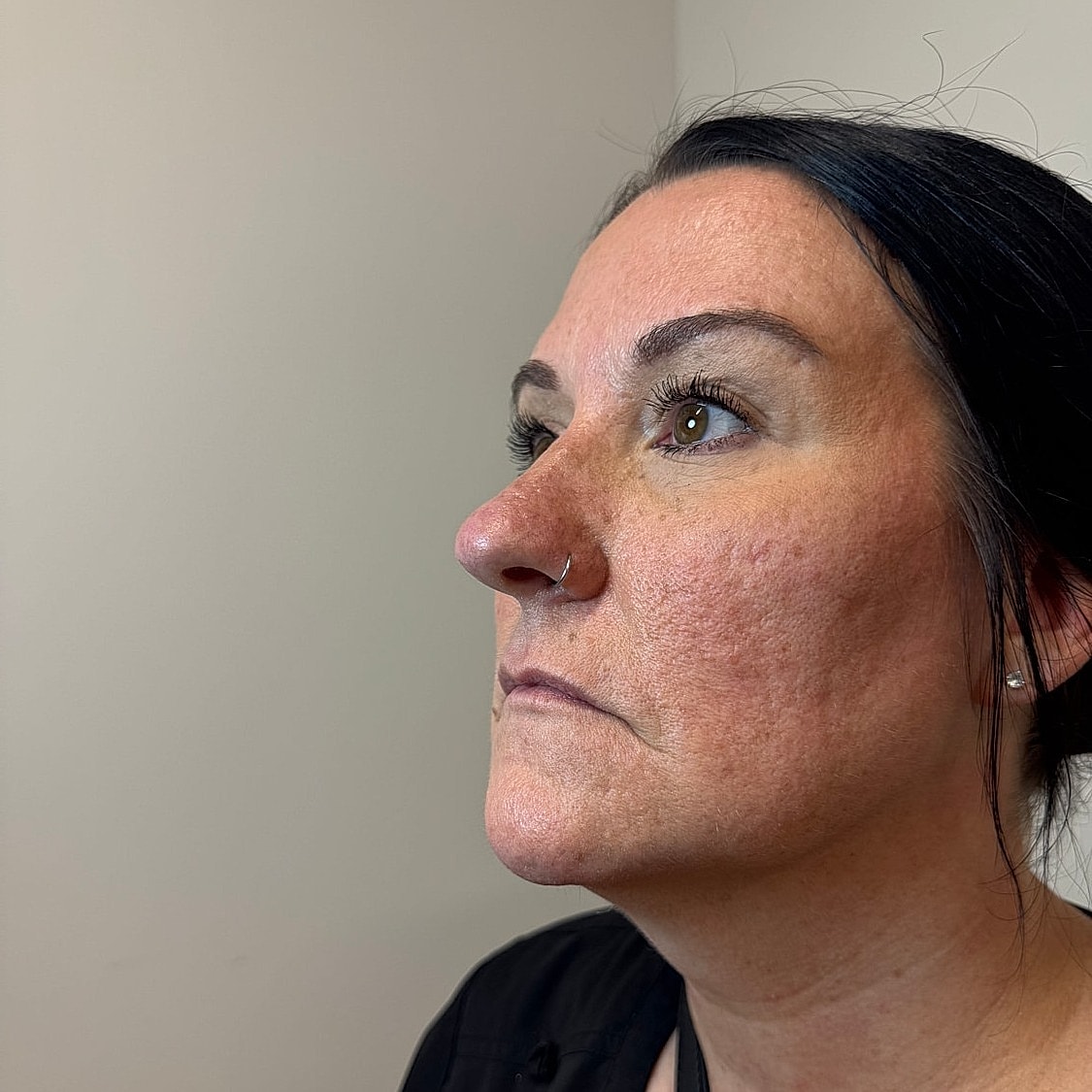 Lip Filler Before & After