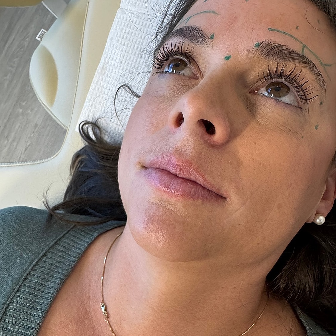 Lip Filler Before & After