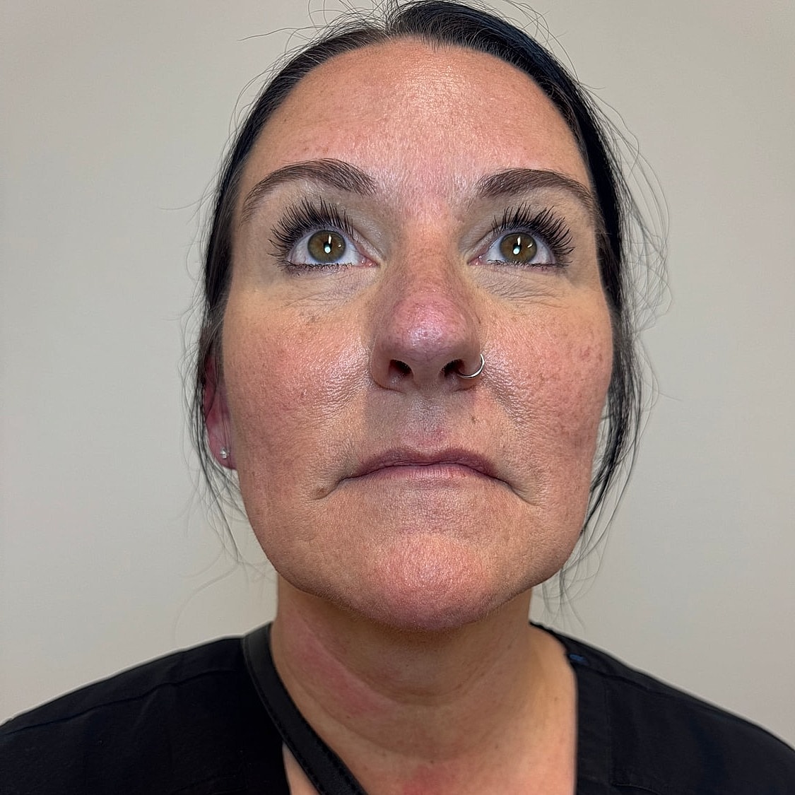 Lip Filler Before & After